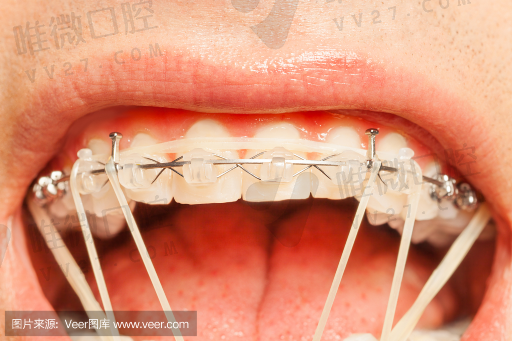 装假牙和种植牙的区别在哪儿,装牙跟原来的牙齿一样吗(图1)